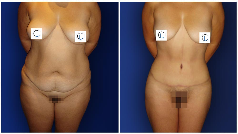 0-march-tummytuck-1